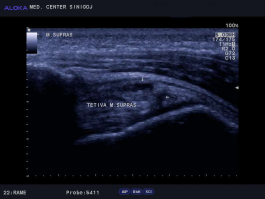 Ultrazvok rame - tendinoza tetive m. supraspinatus z natrganjem